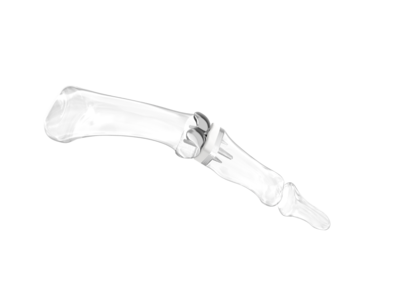 Fingergelenk-Implantat