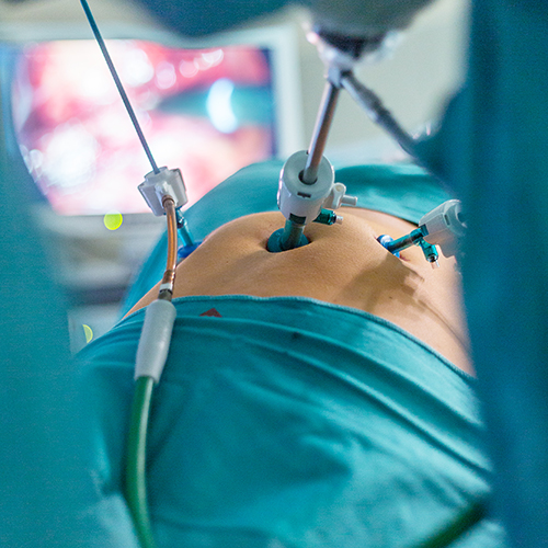 Allgemeinchirurgie Operation